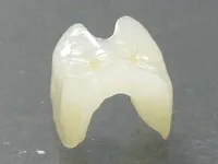 セラミック治療